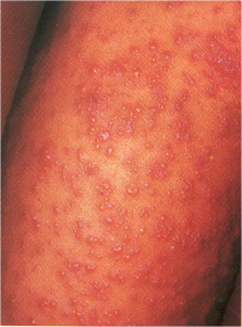 contact_dermatitis